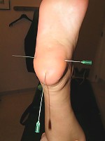 Needles in Feet